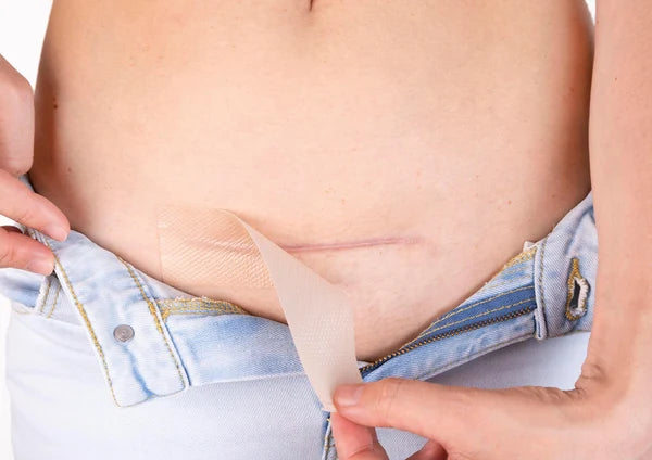 The Cesarean Occlusion Patch®