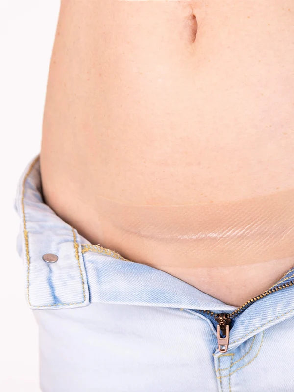 The Cesarean Occlusion Patch®